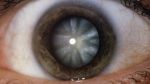 _88653763_m1550050-close-up_of_eye_showing_cataract-spl